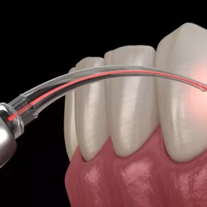 dental-laser-graphic-1 dental-laser-graphic-1